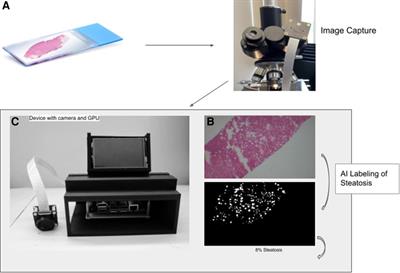 Development of a portable device to quantify hepatic steatosis in potential donor livers